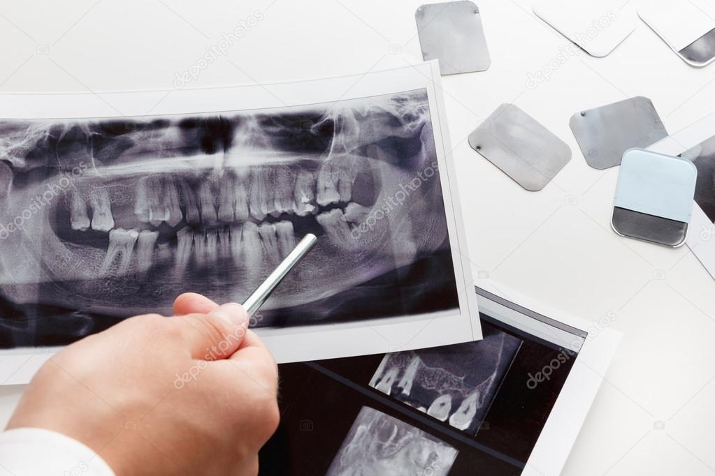 Ilustración radiográfica del hueso maxilar con implante dental